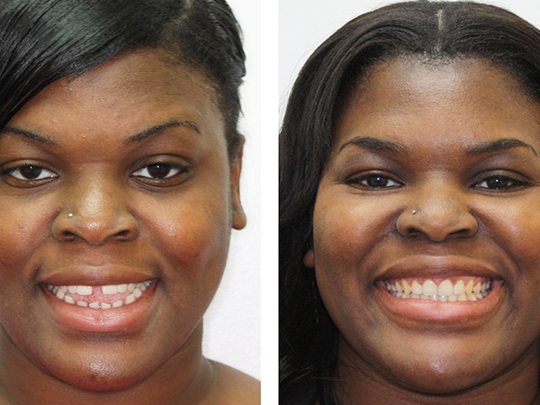 Invisalign Before and After